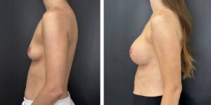 before and after breast augmentation female patient left side view case 2130