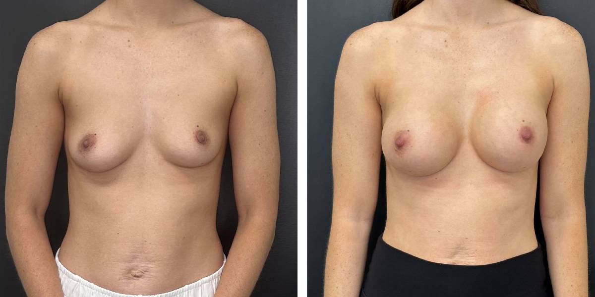 before and after breast augmentation female patient front view case 2130