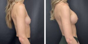 before and after breast augmentation female patient right side view case 2137