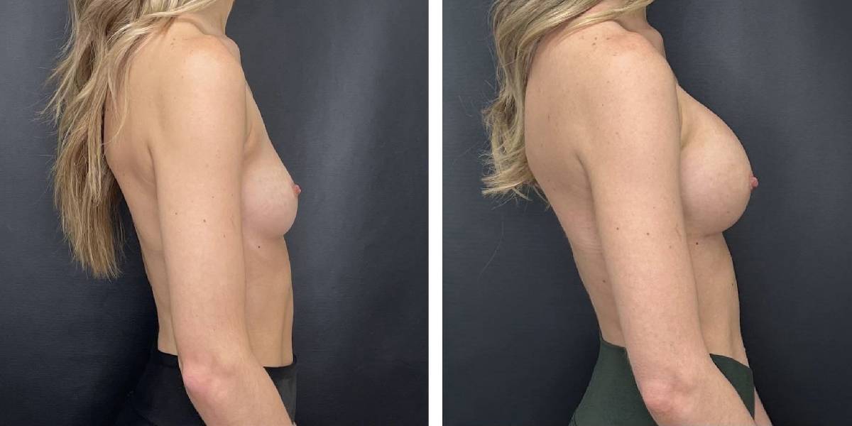 before and after breast augmentation female patient right side view case 2137