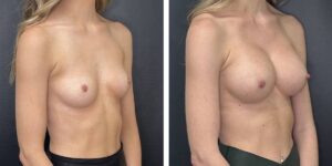 before and after breast augmentation female patient right angled view case 2137