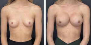 before and after breast augmentation female patient front view case 2137