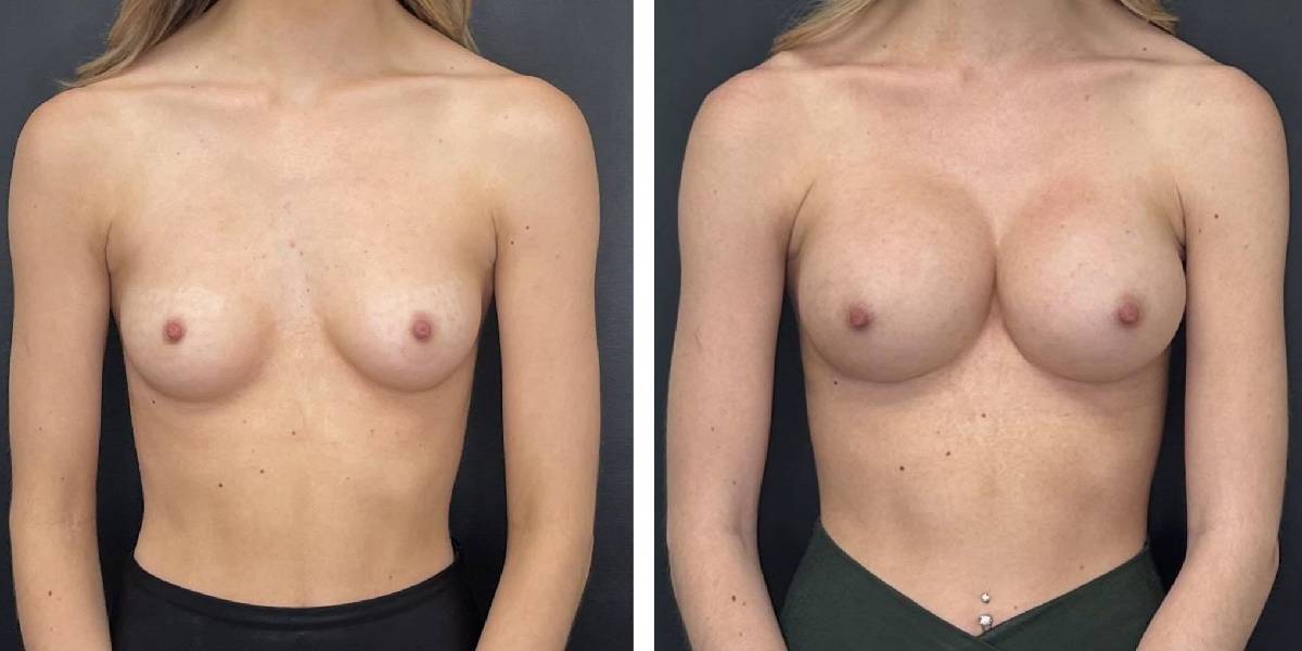 before and after breast augmentation female patient front view case 2137