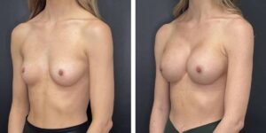 before and after breast augmentation female patient left angled view case 2137