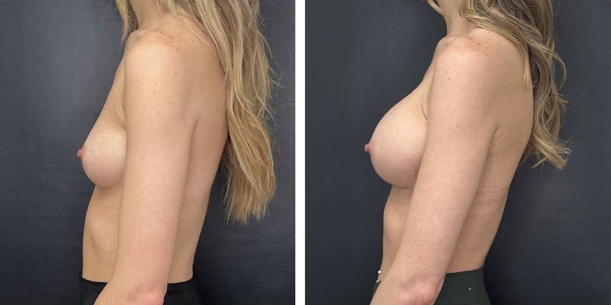 before and after breast augmentation female patient left side view case 2137