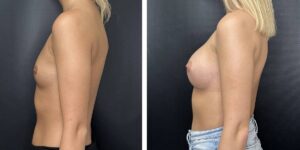 before and after breast augmentation female patient left side view case 2143