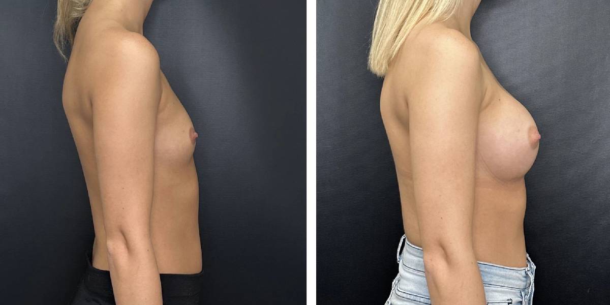 before and after female patient right side view case 2143
