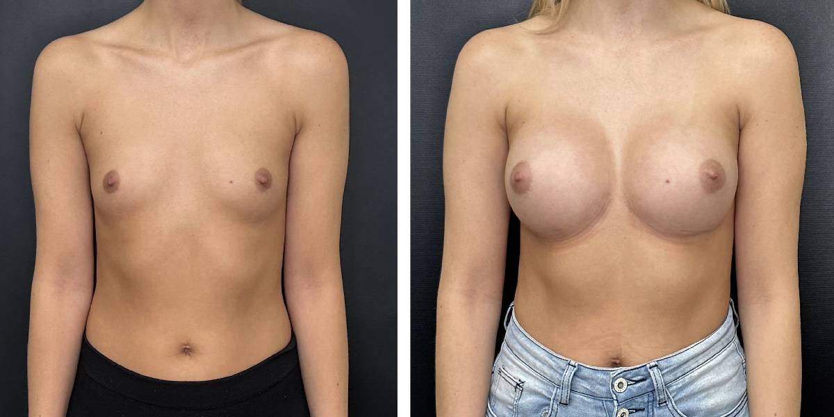 before and after breast augmentation female patient front view case 2143
