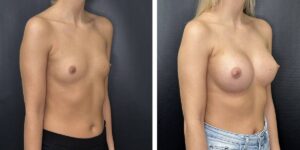 before and after breast augmentation female patient right angled view case 2143
