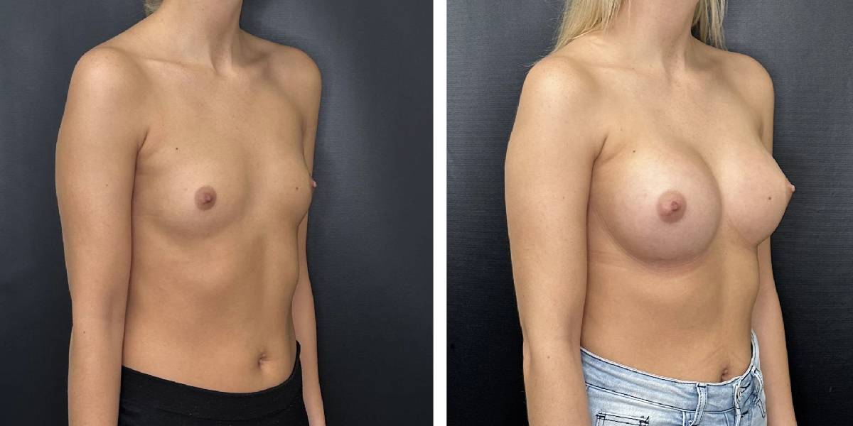 before and after breast augmentation female patient right angled view case 2143