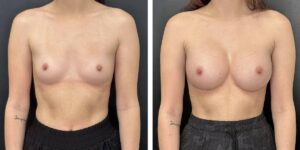 before and after breast augmentation female patient front view case 2152