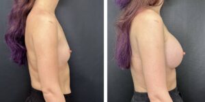 before and after breast augmentation female patient right side view case 2152