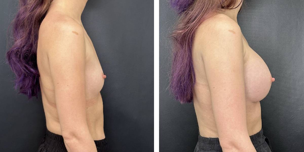 before and after breast augmentation female patient right side view case 2152
