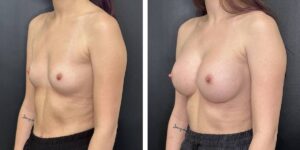 before and after breast augmentation female patient left angled view case 2152
