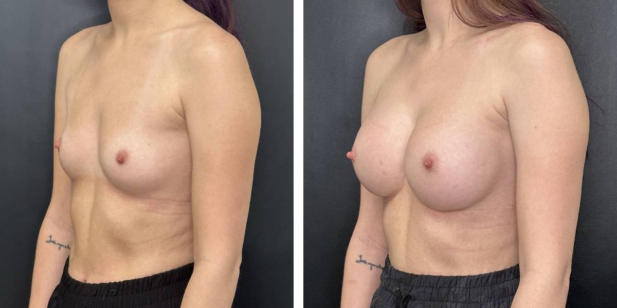 before and after breast augmentation female patient left angled view case 2152