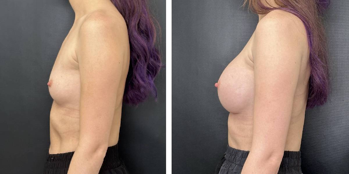 before and after breast augmentation female patient left side view case 2152