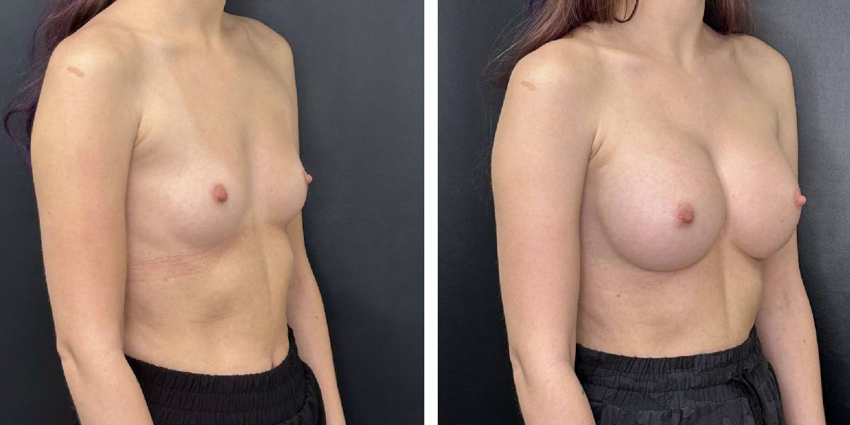 before and after breast augmentation female patient right angled view case 2152