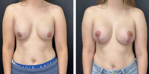 before and after breast implant exchange and breast lift front view case 1330