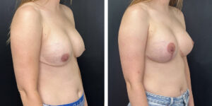 before and after breast implant exchange and breast lift right angled view case 1330