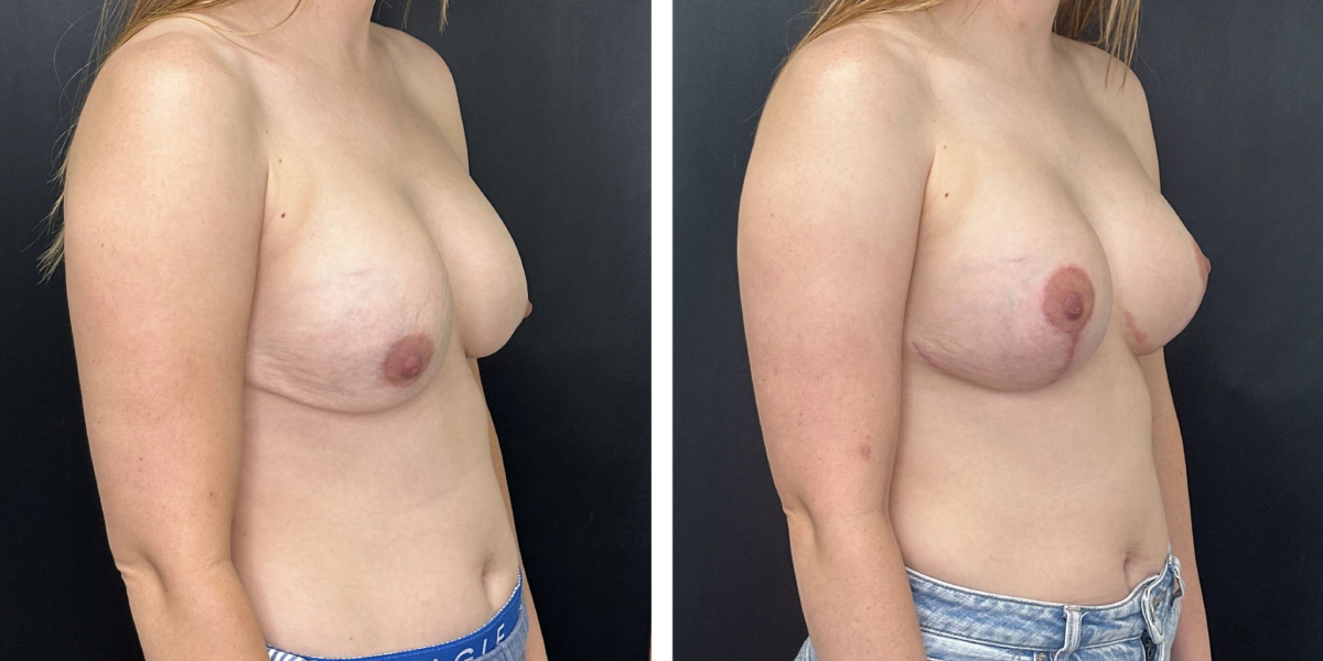 before and after breast implant exchange and breast lift right angled view case 1330