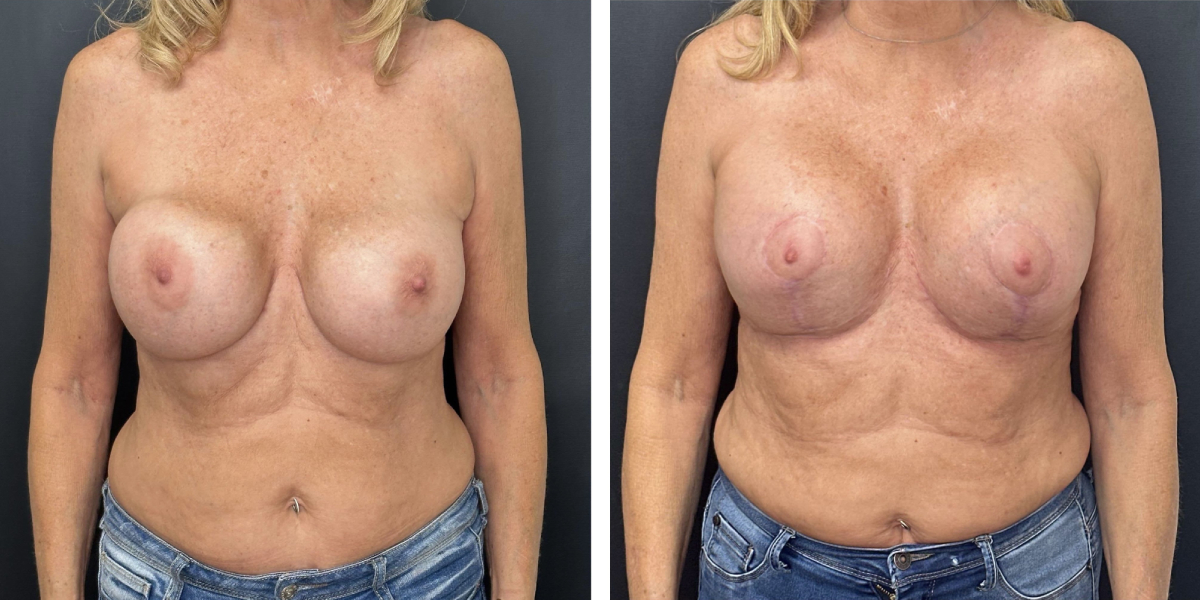 before and after breast implant exchange and breast lift front view case 1336