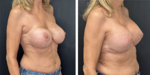before and after breast implant exchange and breast lift right angled view case 1336