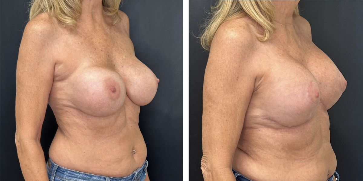 before and after breast implant exchange and breast lift right angled view case 1336