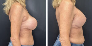 before and after breast implant exchange and breast lift right side view case 1336