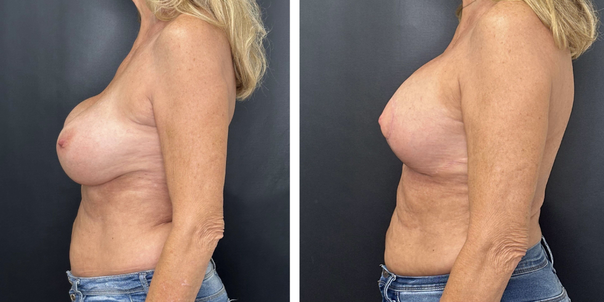 before and after breast implant exchange and breast lift left side view case 1336