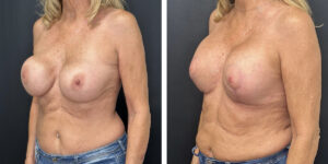before and after breast implant exchange and breast lift left angled view case 1336