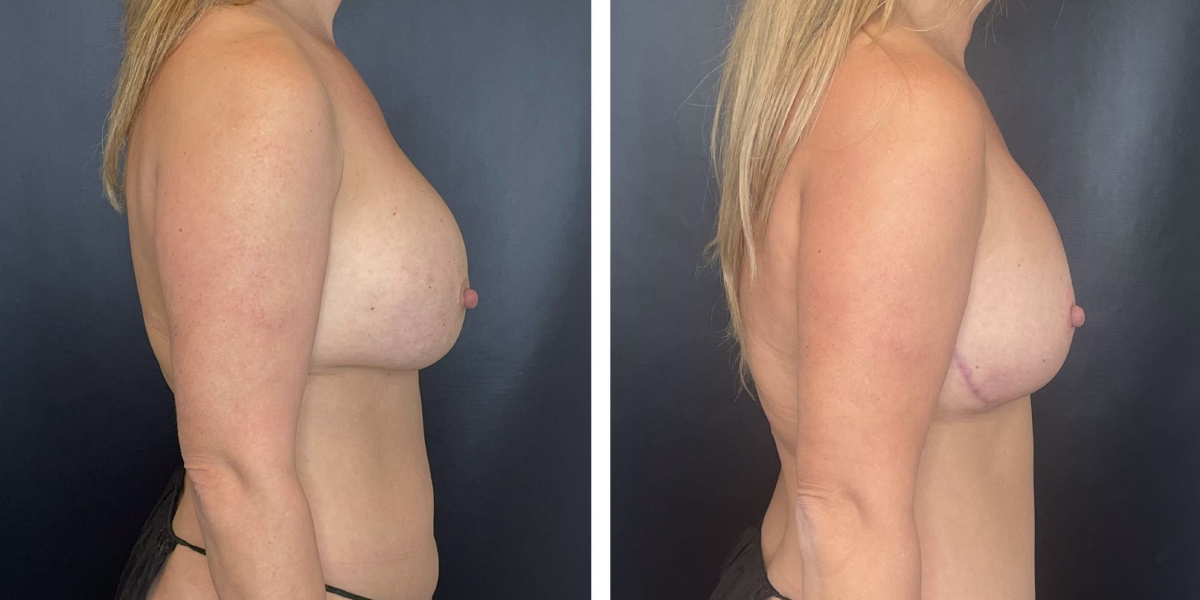 before and after breast implant exchange and breast lift right side view case 1342