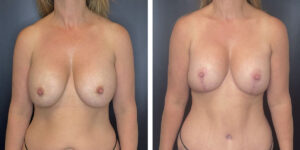 before and after breast implant exchange and breast lift front view case 1342