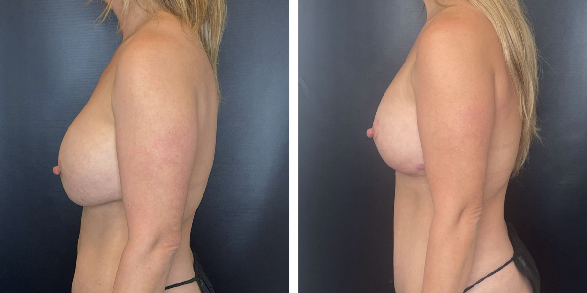 before and after breast implant exchange and breast lift left side view case 1342