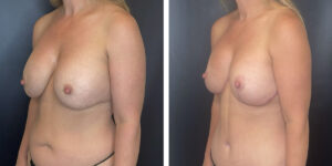 before and after breast implant exchange and breast lift left angled view case 1342