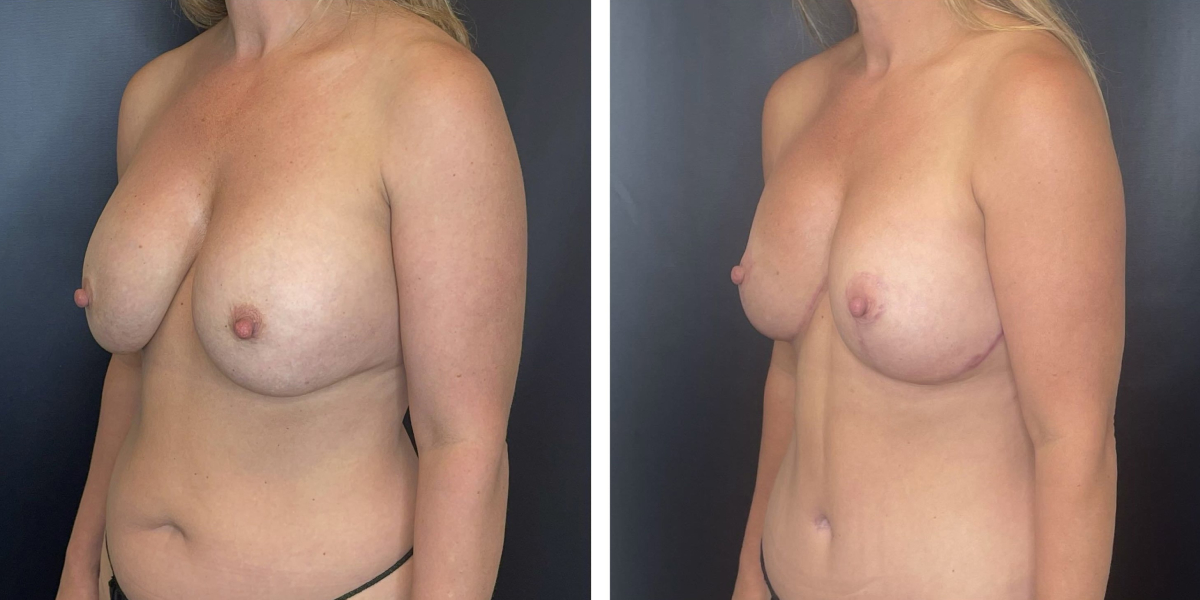 before and after breast implant exchange and breast lift left angled view case 1342