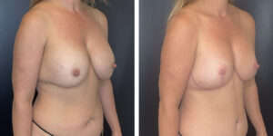 before and after breast implant exchange and breast lift right angled view case 1342