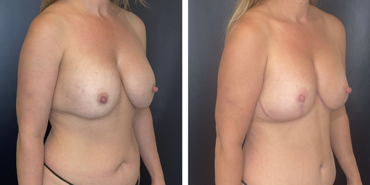 before and after breast implant exchange and breast lift right angled view case 1342