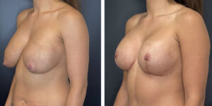 before and after breast implant exchange and breast lift left angled view case 1348