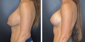 before and after breast implant exchange and breast lift left side view case 1348
