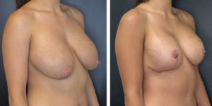 before and after breast implant exchange and breast lift right angled view case 1348