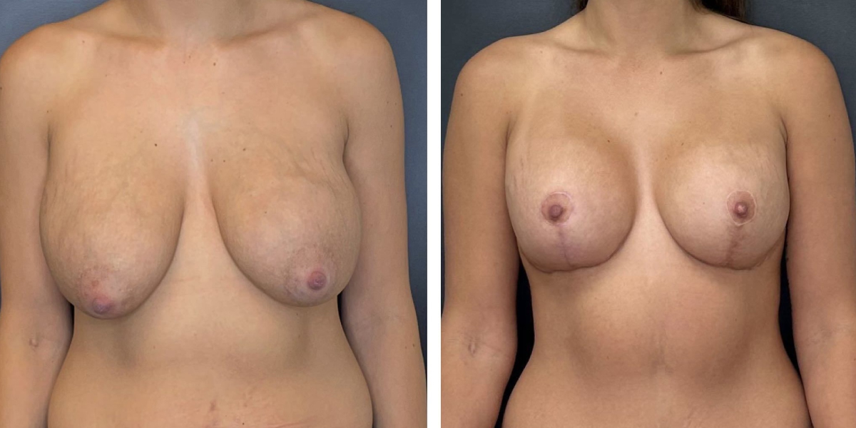 before and after breast implant exchange and breast lift front view case 1348