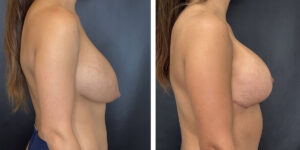 before and after breast implant exchange and breast lift right side view case 1348