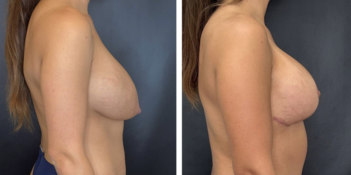 before and after breast implant exchange and breast lift right side view case 1348