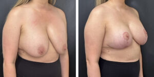 before and after breast implant exchange and breast lift right angled view case1354
