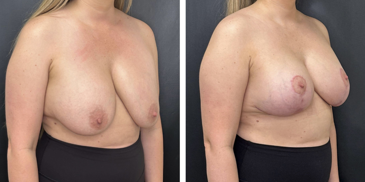 before and after breast implant exchange and breast lift right angled view case1354