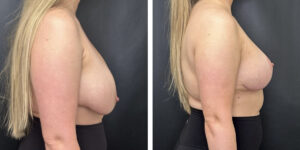before and after breast implant exchange and breast lift right side view case 1354