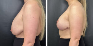 before and after breast implant exchange and breast lift left side view case 1354