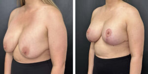 before and after breast implant exchange and breast lift left angled view case 1354