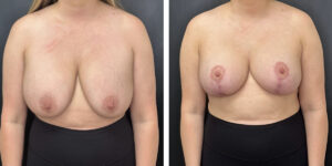 before and after breast implant exchange and breast lift front view case 1354