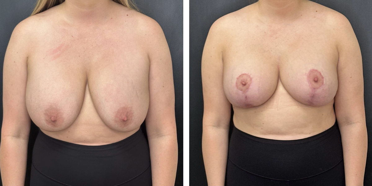 before and after breast implant exchange and breast lift front view case 1354